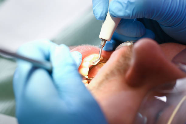 Best Emergency Root Canal Treatment in Batavia, NY
